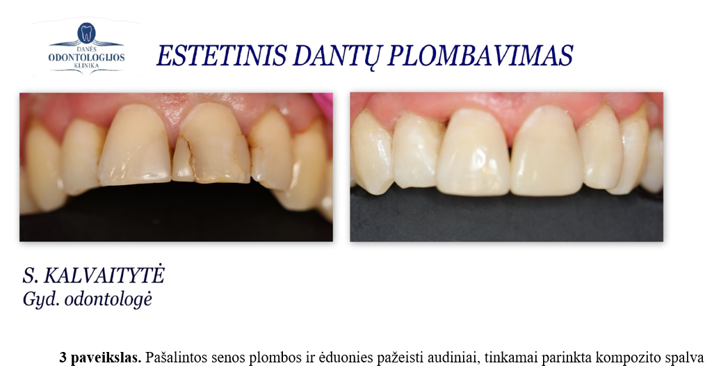 Dantų spalvos pokyčiai: išoriniai ir vidiniai veiksniai